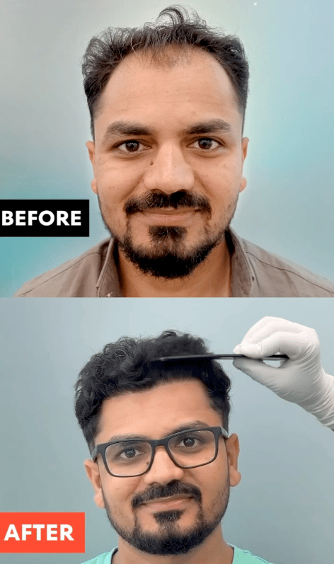 Sapphire implantation phase