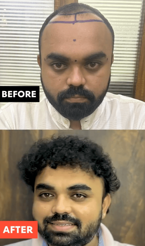 Before hair-transplant