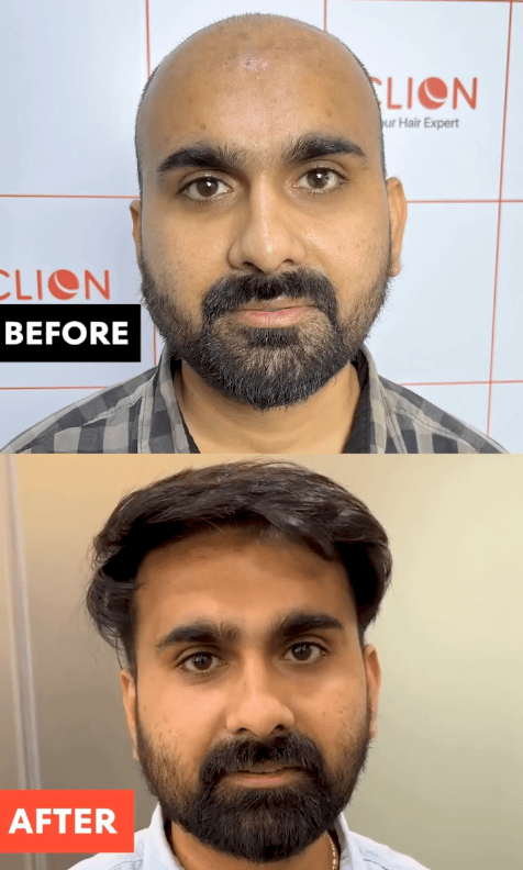 After hair-transplant, twelve months