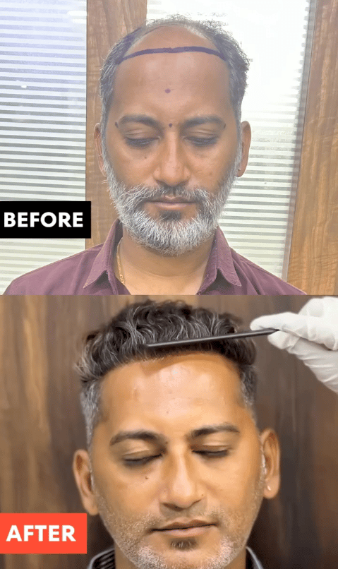 A restored hairline, twelve months post-procedure.